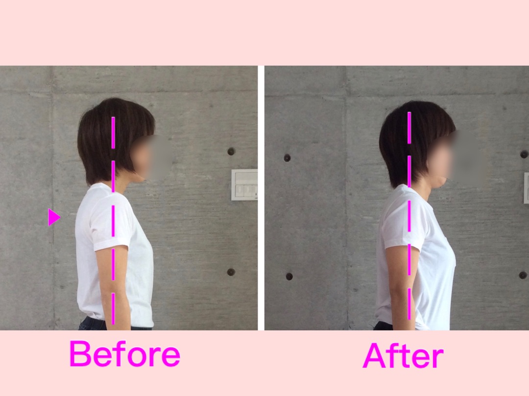 猫背ビフォーアフター